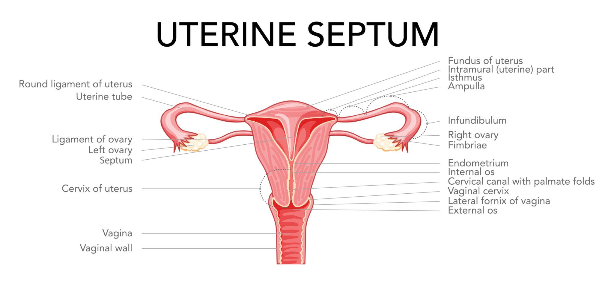 Laparoscopic Septate Uterus Treatment in Pune – Advanced Fertility-Focused Care